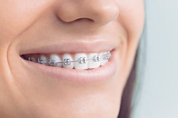InBraces-Lingual_edited1-1
