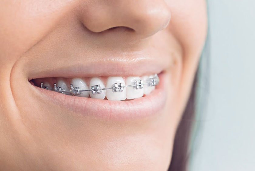 InBraces-Lingual_edited1-1 InBraces-Lingual_edited1-1